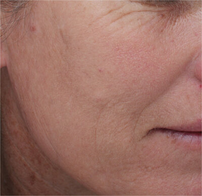 Beauty and Grace Aesthetics Botox patient before and after