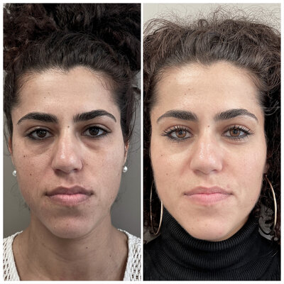 Before after fillers door Dr Lizenka Adriaanse cosmetisch arts Rotterdam