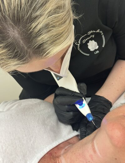 Skin Rejuvenating plasma treatment at Luscious skin & Beauty Warrnambool