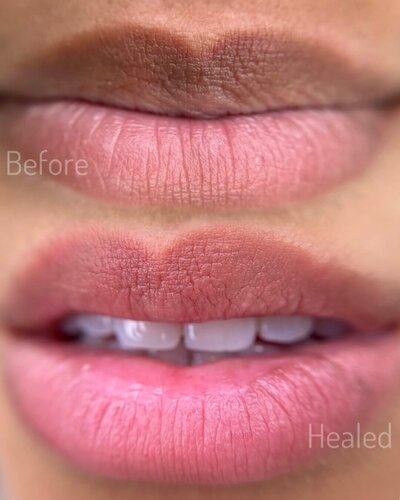 lips neutralization in New York