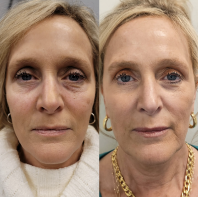 Neurotoxin, PDGF, and IPL results

