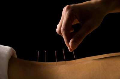 acupuncture mount maunganui , acupuncture tauranga, acupuncture bay of plenty, acupuncturist