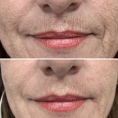Lipfillers door cosmetisch arts Lizenka Adriaanse in Rotterdam