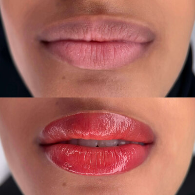Lip Neutralization New York