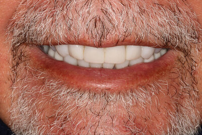 Implants by Sweet Tooth Dental Wellness & Implants Cincinnati, OH -5