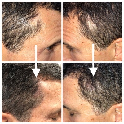Miconeedling to stimulate hair growth & conceal bald spots.