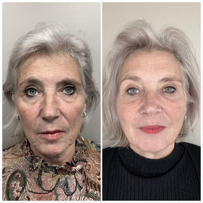 Before after liquid facelift Lizenka Adriaanse cosmetisch arts Rotterdam
