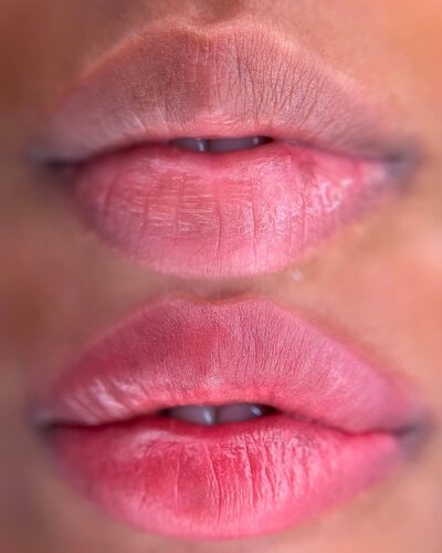Lip Neutralization New York
