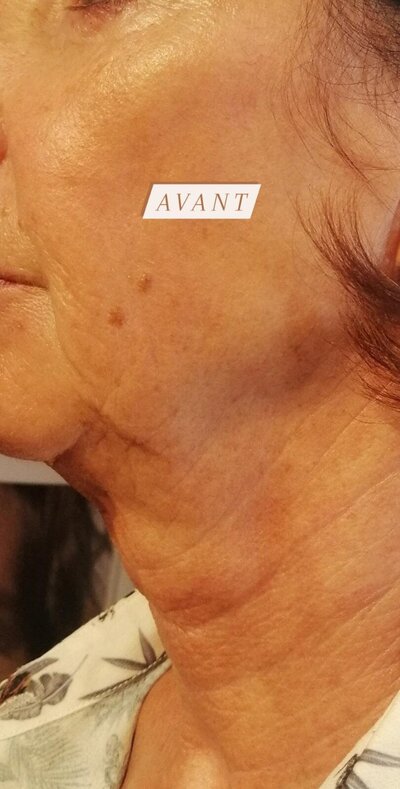 avant après salon esthétique trait delicat Montlucon