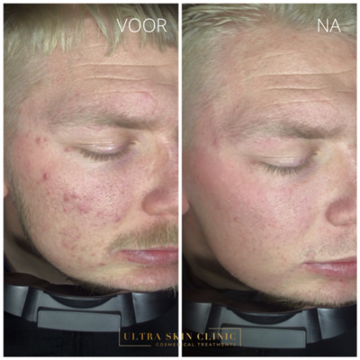 acnetherapie zijkant 1 ultra skin clinic