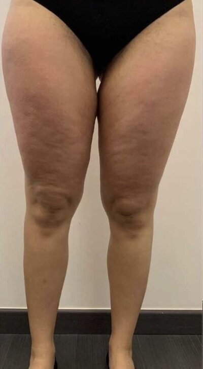 avant après d'une femme avec moins de cellulite