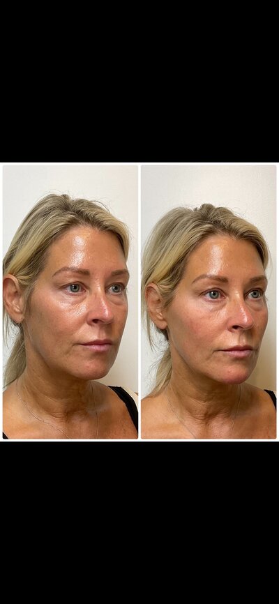 KM_cheek.chin filler_before&after2