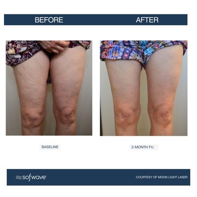 Set-80-Cellulite