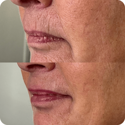 Perioral line correction before and after