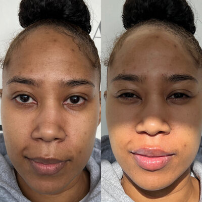 Woman before and after lip filler larger lips natural in St. Clair Shores Michigan