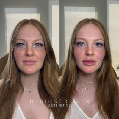 Before and after lip filler treatment in Orange County, Russion Lips