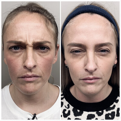 Botox before after door Lizenka Adriaanse cosmetisch arts Rotterdam
