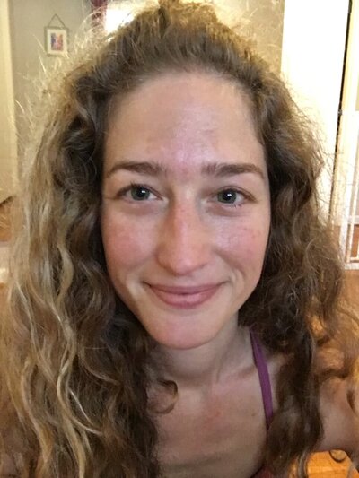 woman with melasma starting to develop on her forehead and cheeks