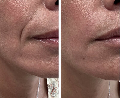 Filler mondhoeken door cosmetisch arts Lizenka Adriaanse in Rotterdam