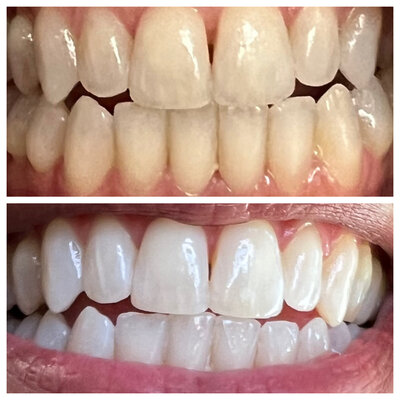 Before & After Teeth Whitening experience at WhitenUp Teeth Whitening Spa. Top photo shows teeth before, which are stained and yellow. Bottom photo shows teeth after, which are bright and white.