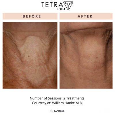 Tetra Pro before and after photo