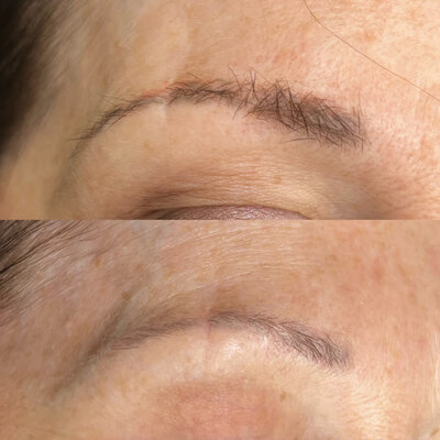 Before and after picture of saline cosmetic tattoo removal