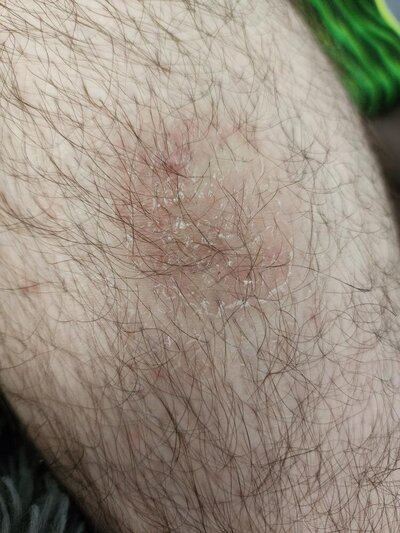 Tallow skincare Indiana healing eczema one week