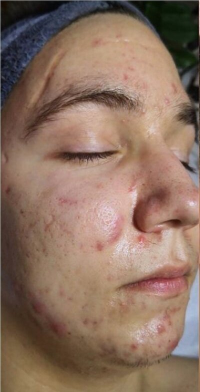 avant après du jet peel