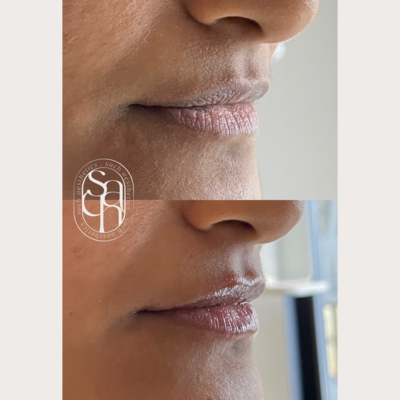 lip filler before and after on smaller, thin lips