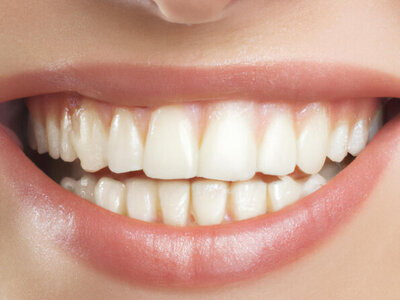 Teeth whitening and cosmetic dentistry to create a perfect white smile.