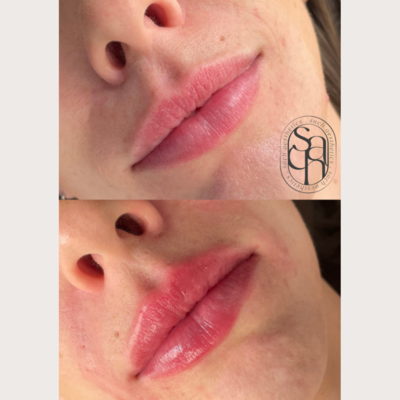 NYC NJ lip filler before and after indian south asian woman natural