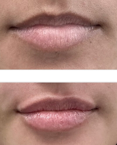 Lipfillers door cosmetisch arts Lizenka Adriaanse in Rotterdam