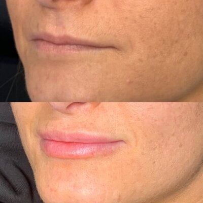 Lip injection before and after results from Refresh Aesthetics