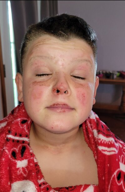 Tallow skincare Indiana healing second degree burns