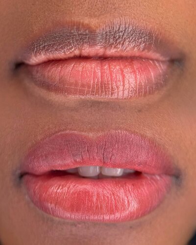 Lip Neutralization New York