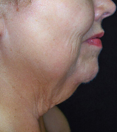Beauty and Grace Aesthetics Botox patient before and after