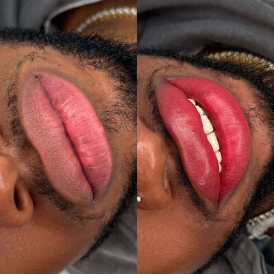 Lip Neutralization nyc