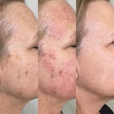 Progress shot of IPL treatment on skin pigmentation