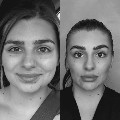 Botox smooths fine lines and wrinkles at Luna Skin, esthetician in Bryan TX, serving College Station clients