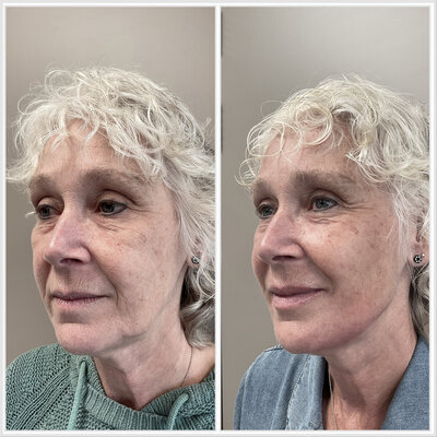 Before after liquid facelift Lizenka Adriaanse cosmetisch arts Rotterdam