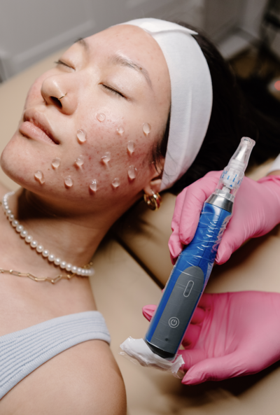 microneedling for acne scarring and fine lines in barrington.