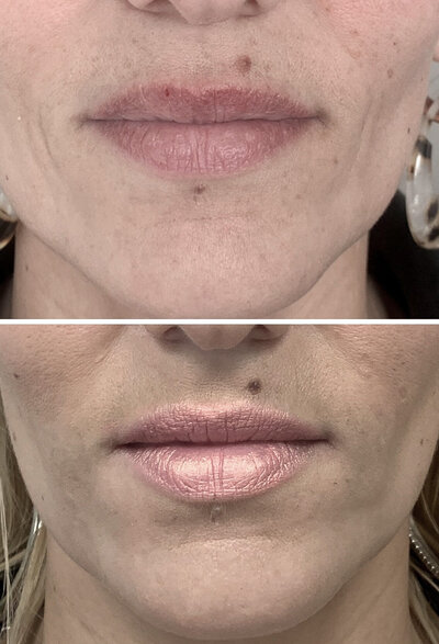 Lipfillers door cosmetisch arts Lizenka Adriaanse in Rotterdam