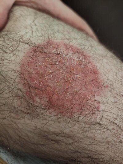 Tallow skincare Indiana healing eczema one week