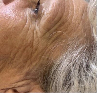 avant après cure jet peel effet antiage