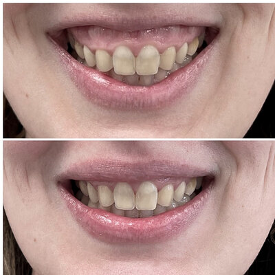 Botox gummysmile before after door cosmetisch arts Lizenka Adriaanse in Rotterdam