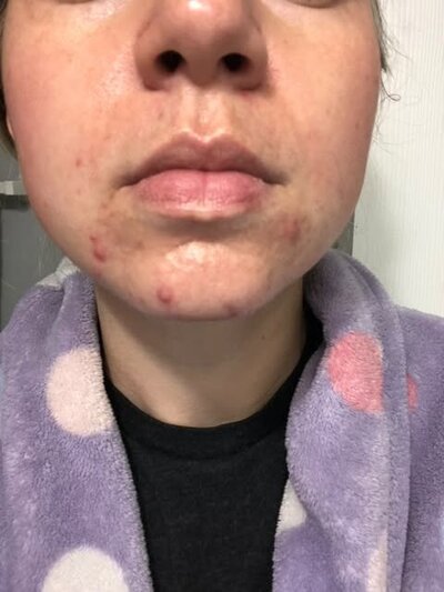 Chin pimples and hormones