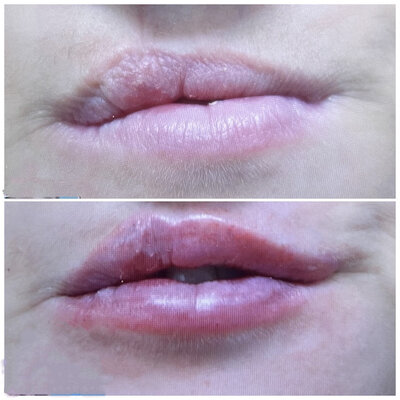 Lipfillers door cosmetisch arts Lizenka Adriaanse in Rotterdam