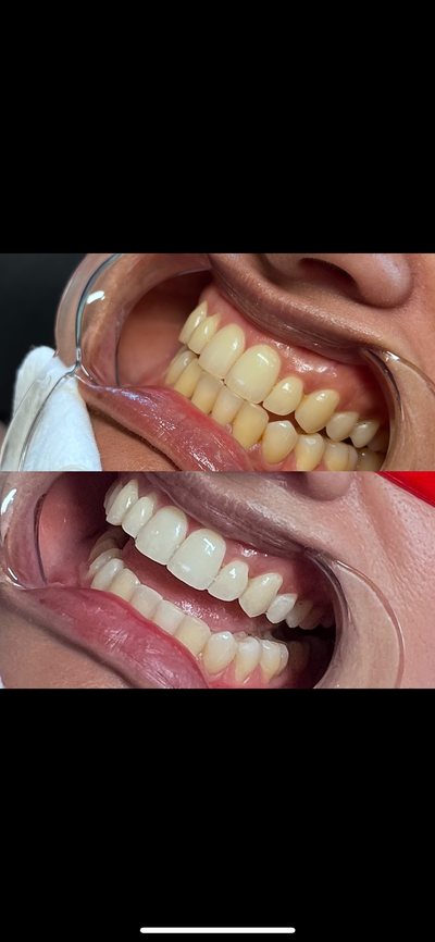 Before and after teeth whitening. One part of the images shows a before image of very yellow teeth and the after image shows freshly whitened teeth and they are much whiter than the before image.