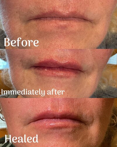 Lip filler before and after photo