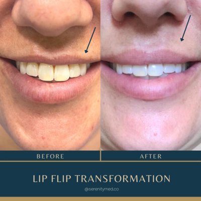 botox for lips